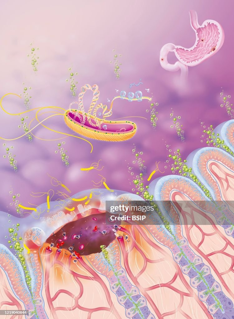 ULCERE GASTRODUODENAL