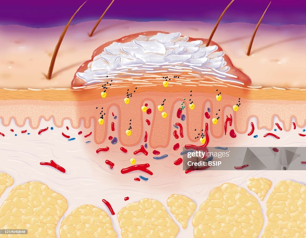 Psoriasis