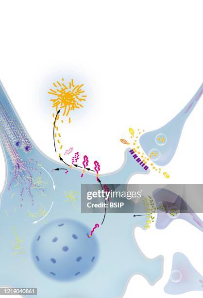 Neuron with neurofibrillary degeneration process, senile plaque, treatments. Neuron in the central nervous system affected by abnormal cleavage of...