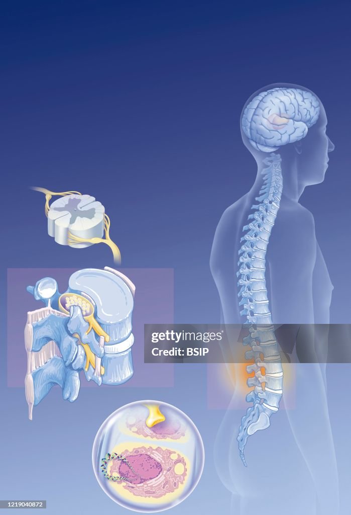 LOW BACK PAIN