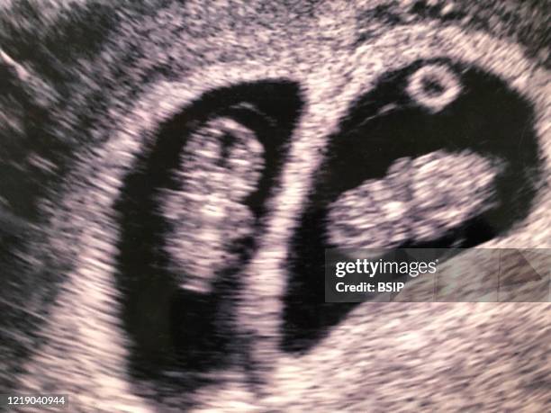 Twin Fetal Ultrasound, each egg has its placenta and amniotic pocket.