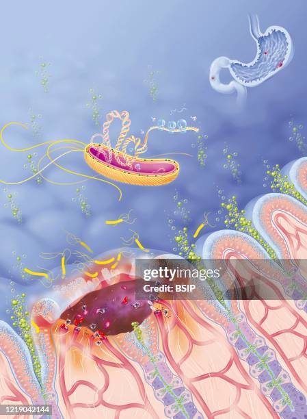 Site of action of drugs in the treatment of peptic ulcer. Zoom on the gastric mucosa seen in section. On the left, an ulcer in the presence of...