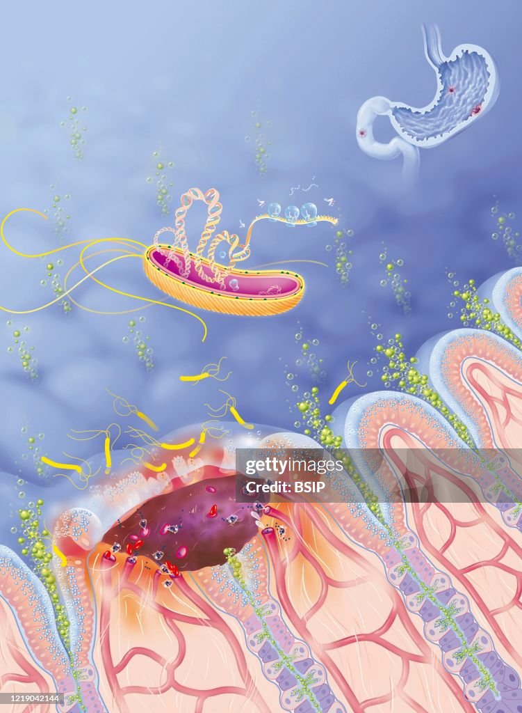 Peptic ulcer