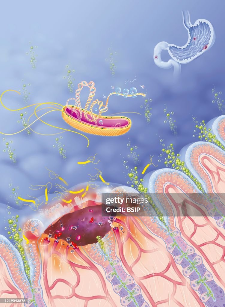 ULCERE GASTRODUODENAL