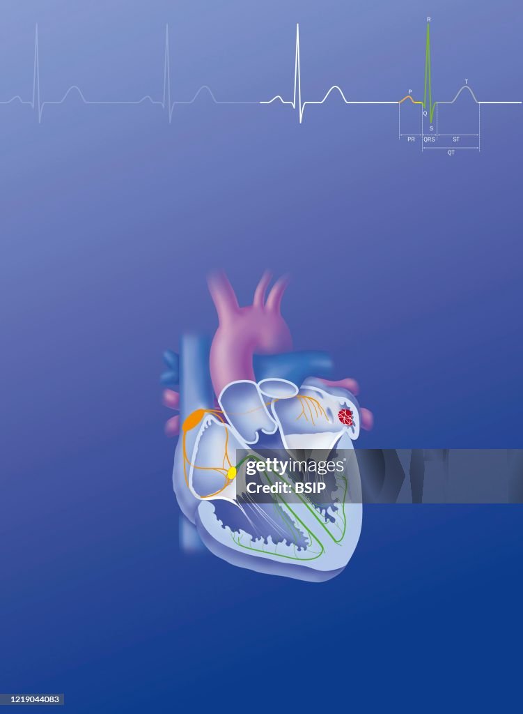 Atrial fibrillation