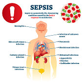 Sepsis vector illustration. Labeled infection condition educational scheme.