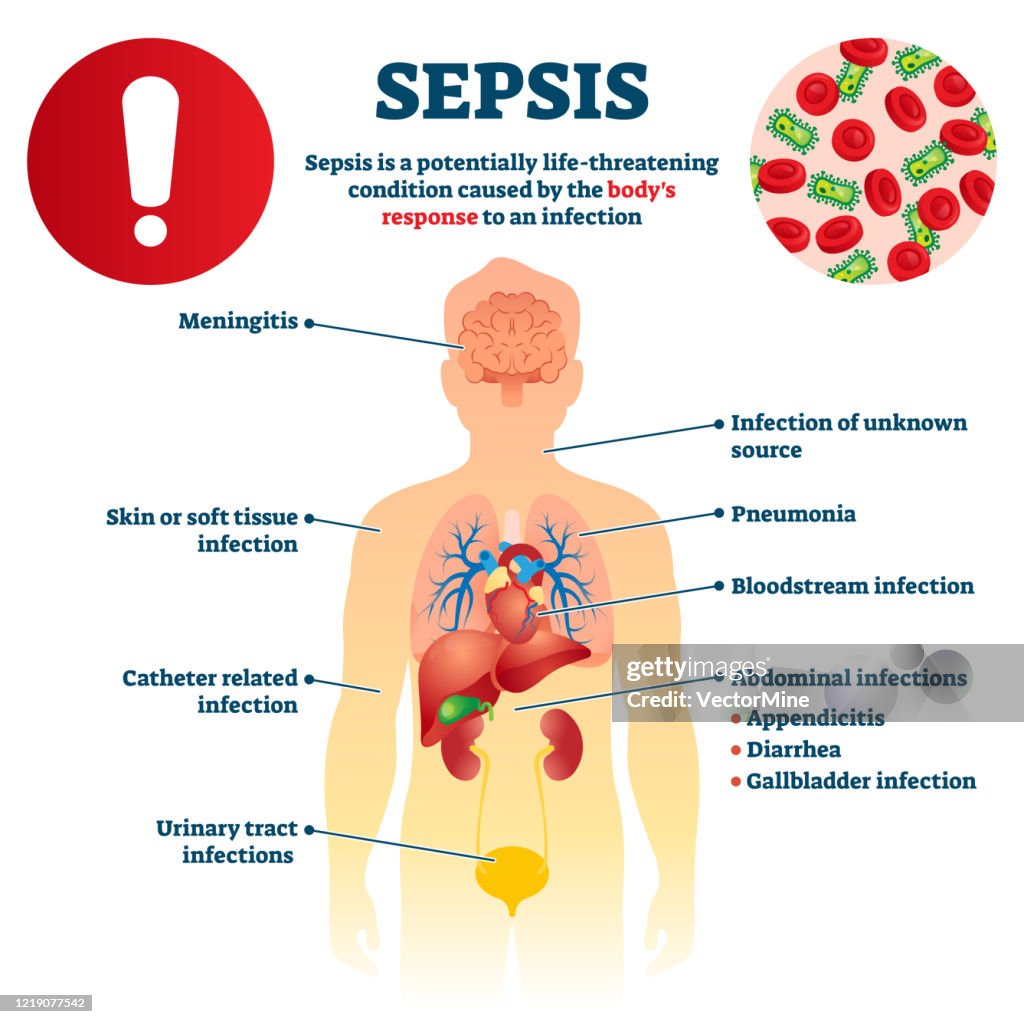 Sepsis Vector Illustration Labeled Infection Condition Educational sepsis-vector-illustration-labeled-infection-condition-educational