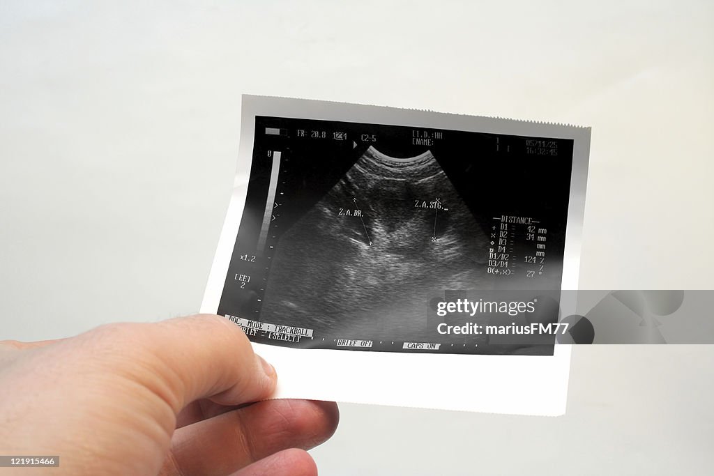 Ovary sonogram 2