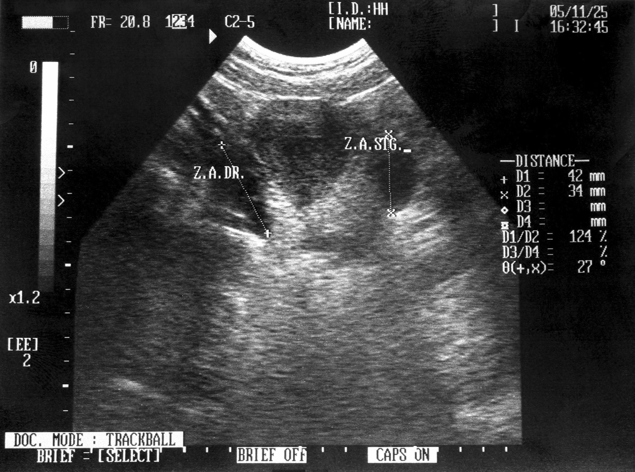 pregnant woman ultrasound