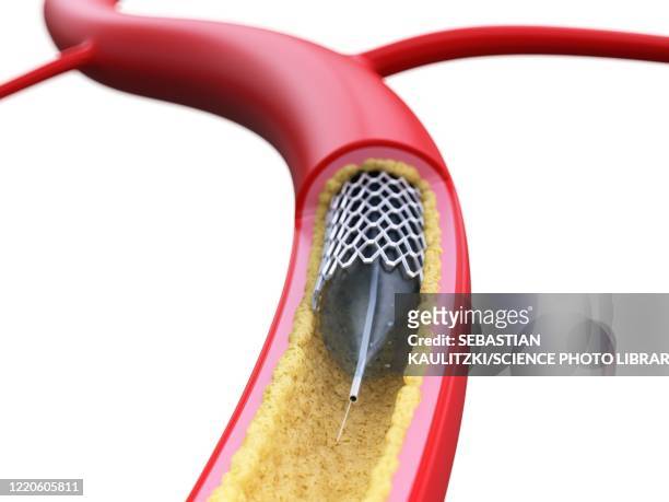 stent inside of an artery, illustration - coronary artery点のイラスト素材／クリップアート素材／マンガ素材／アイコン素材