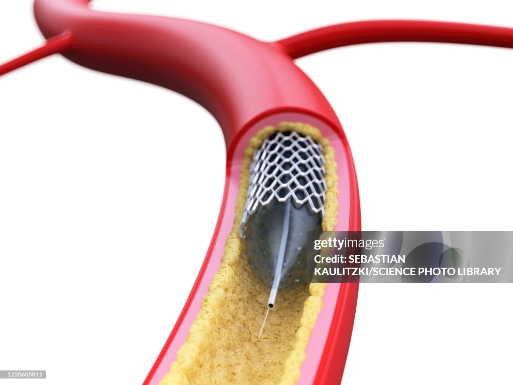 Stent inside of an artery, illustration