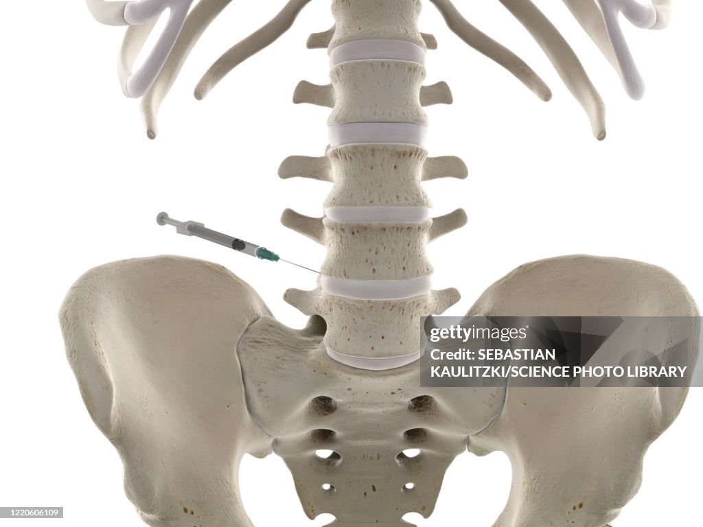 Lumbar Spine Injection Illustration High-Res Vector Graphic - Getty Images