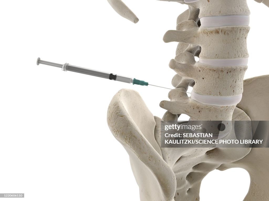 Spinal Injection Layers Lumbar Spine Injection Illustration High-Res Vector Graphic - Getty Images
