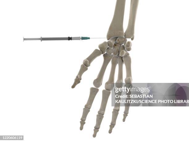 wrist injection, illustration - hand holding tissue stock illustrations