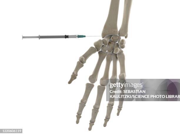 wrist injection, illustration - physik stock illustrations