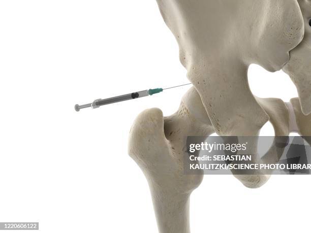 hip joint injection, illustration - injecting stock illustrations