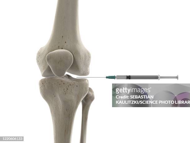 knee joint injection, illustration - femur stock-grafiken, -clipart, -cartoons und -symbole