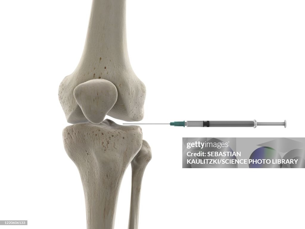Knee Joint Injection Illustration High-Res Vector Graphic - Getty Images