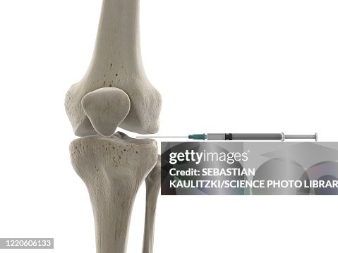 Knee Joint Injection Illustration High-Res Vector Graphic - Getty Images