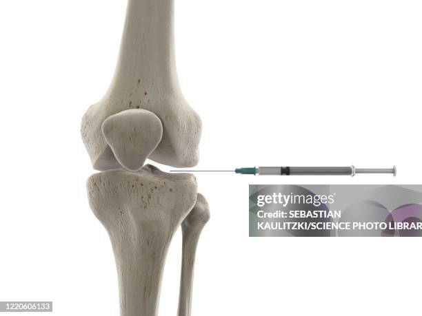 knee joint injection, illustration - needle injury stock illustrations