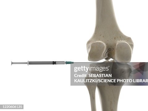 Left Knee Injection Knee Joint Injection Illustration High-Res Vector Graphic - Getty Images