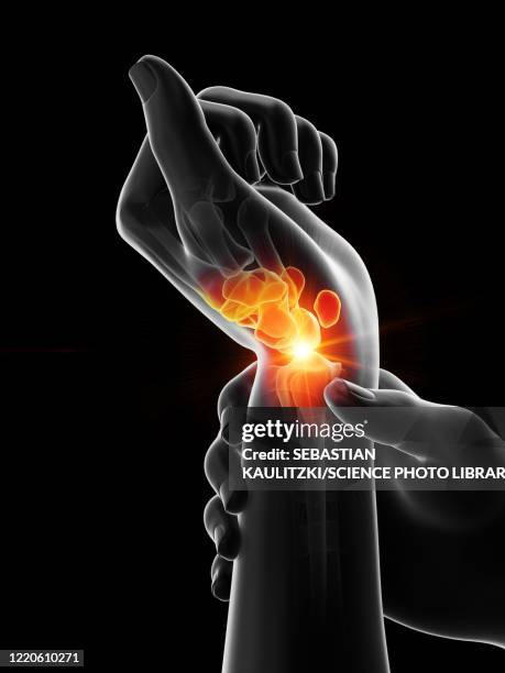 stockillustraties, clipart, cartoons en iconen met painful wrist, illustration - osteoporose