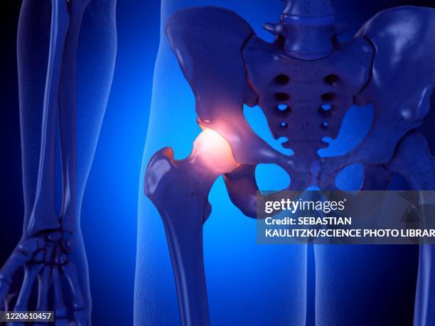 painful hip joint, illustration - menschliches bein stock-grafiken, -clipart, -cartoons und -symbole