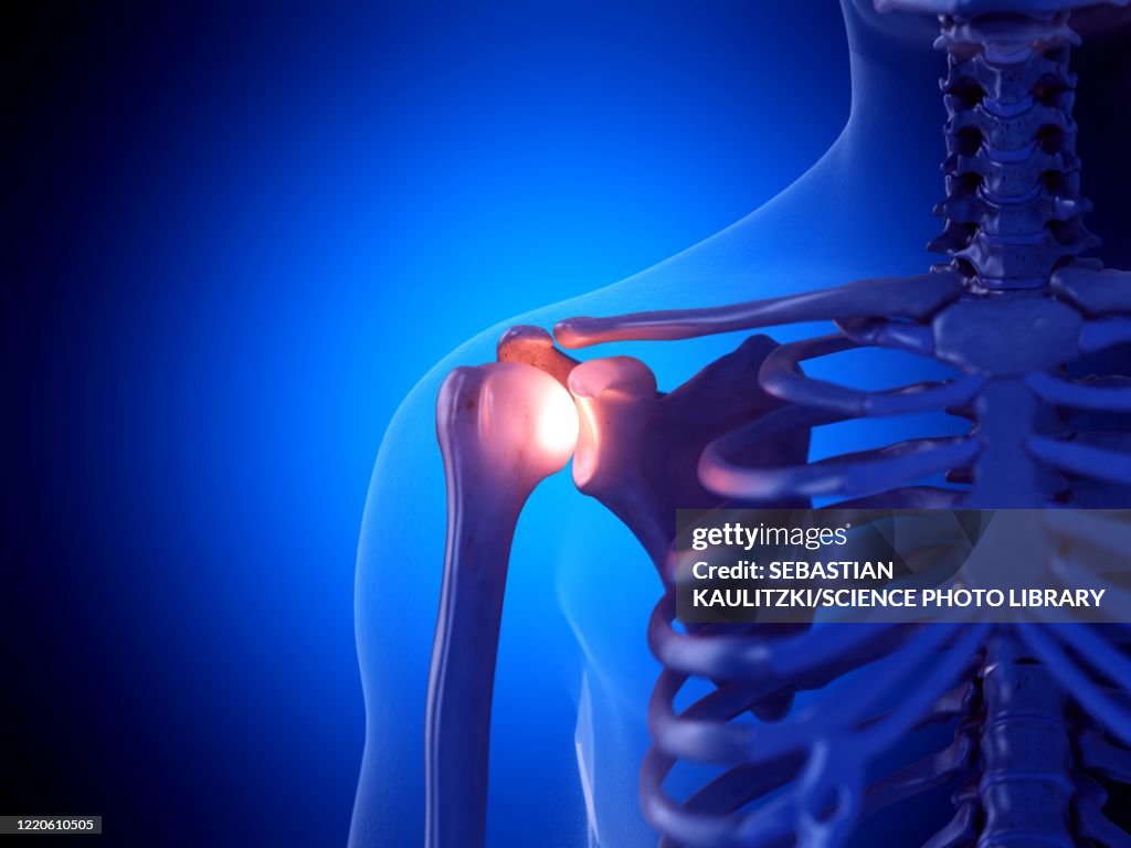 Painful shoulder joint, illustration