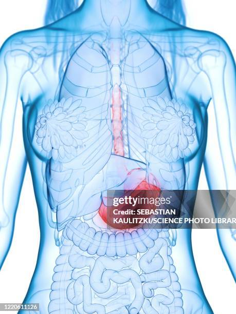diseased stomach, illustration - refluxkrankheit stock-grafiken, -clipart, -cartoons und -symbole