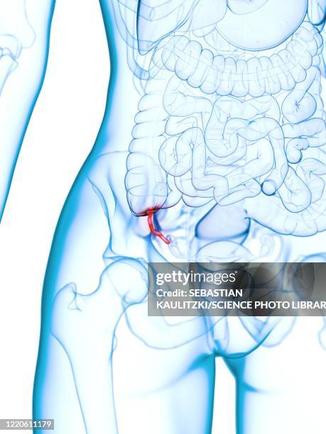 ilustrações de stock, clip art, desenhos animados e ícones de inflamed appendix, illustration - appendicitis