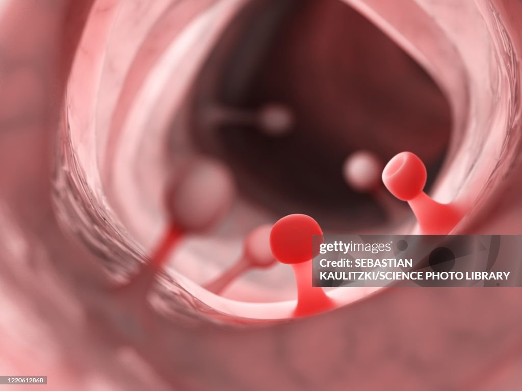 Polyps Animation Colon Polyps Illustration Ilustración de stock - Getty Images