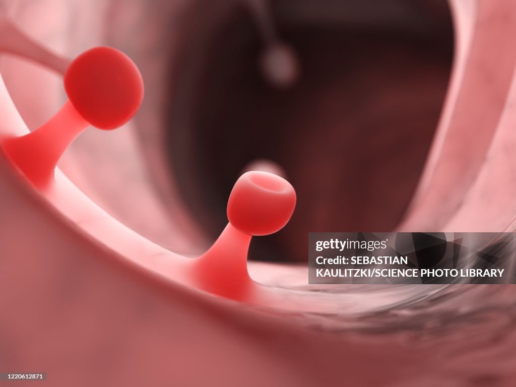 Polyps Animation Colon Polyps Illustration High-Res Vector Graphic - Getty Images