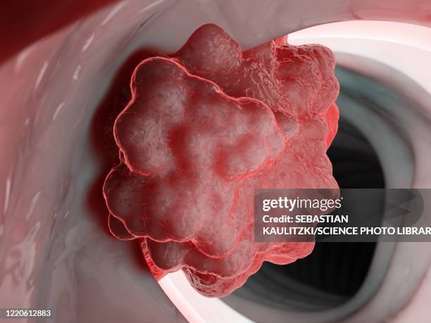 Polype Photo Colonoscopy Polyp Photos and Premium High Res Pictures - Getty Images