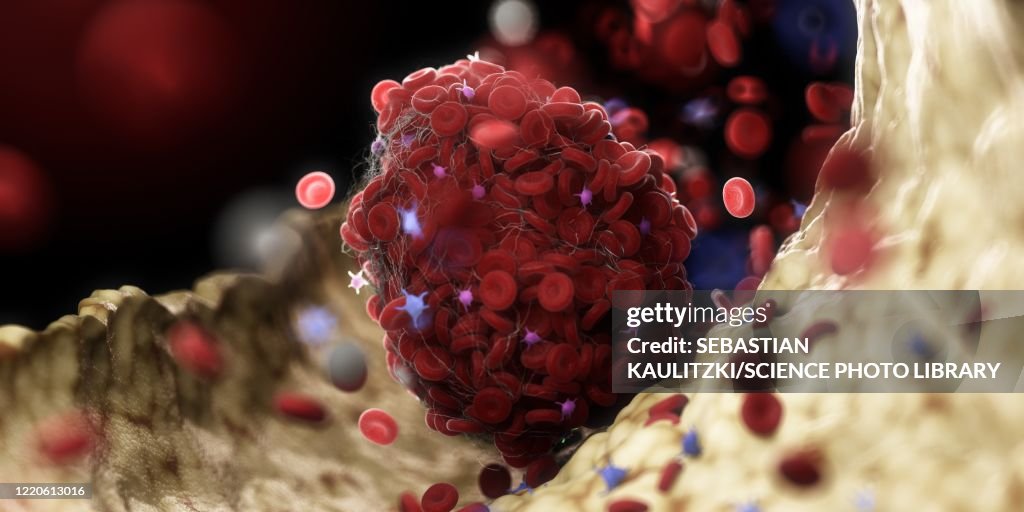 Thrombus, illustration