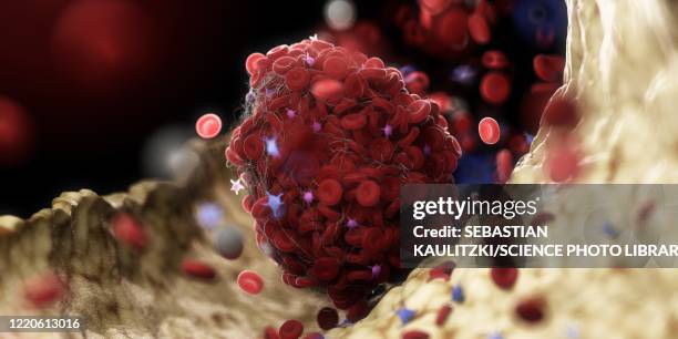 thrombus, illustration - coagulation stock illustrations