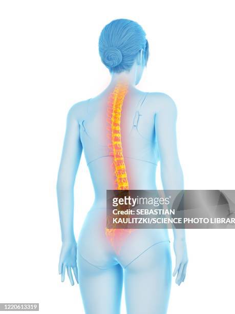 stockillustraties, clipart, cartoons en iconen met woman with backache, illustration - osteoporose