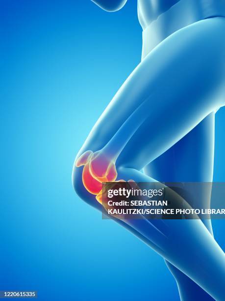 ilustrações, clipart, desenhos animados e ícones de woman with a painful knee, illustration - osteoporose