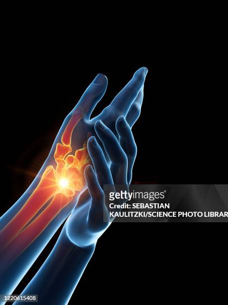 stockillustraties, clipart, cartoons en iconen met woman with a painful hand, illustration - osteoporose