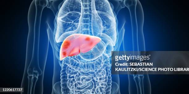 ilustraciones, imágenes clip art, dibujos animados e iconos de stock de liver tumours, illustration - higado