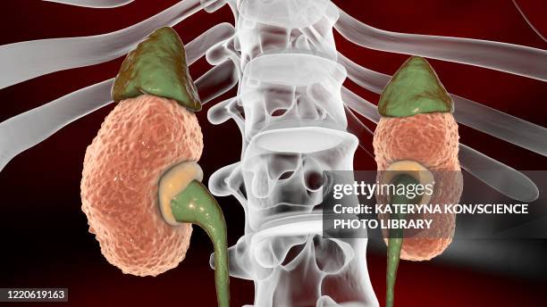 chronic kidney disease, illustration - cyst stock illustrations