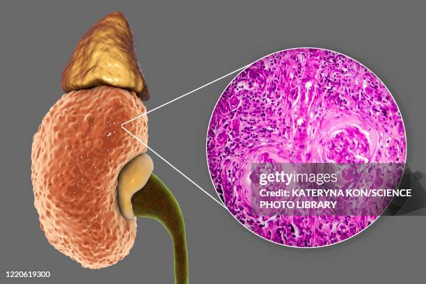 chronic kidney disease, illustration and light micrograph - light micrograph stock illustrations