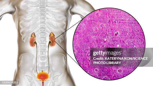 chronic kidney disease, illustration and light micrograph - kidney micrograph stock illustrations