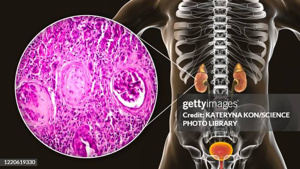 chronic kidney disease, illustration and light micrograph - light micrograph stock illustrations