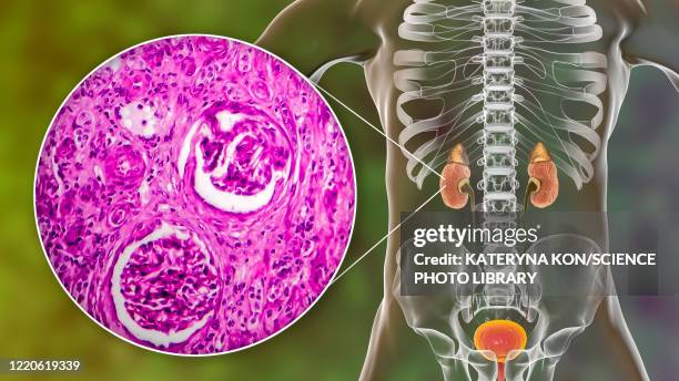 chronic kidney disease, illustration and light micrograph - light micrograph stock illustrations