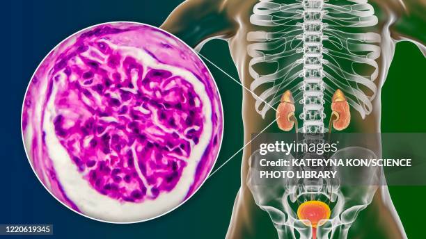 chronic kidney disease, illustration and light micrograph - light micrograph stock illustrations
