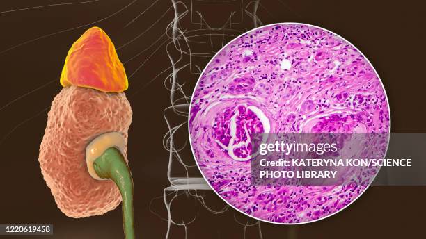chronic kidney disease, illustration and light micrograph - chronic illness stock illustrations