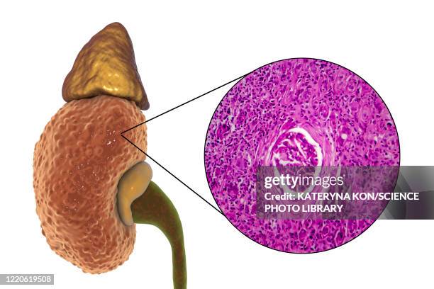 chronic kidney disease, illustration and light micrograph - light micrograph stock illustrations