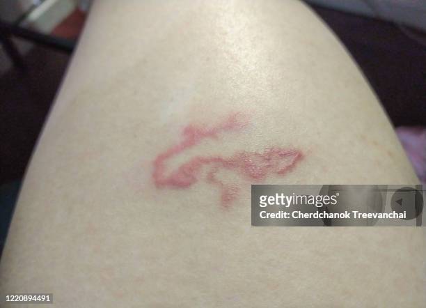 creeping eruption or cutaneous larva migrant on the leg, disease - parasitic ストックフォトと画像