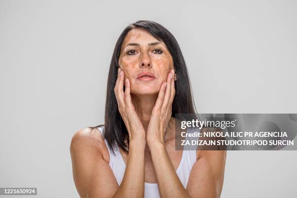 mooie kaukasische hogere vrouw met huidproblemen vitiligo - vitiligo face stockfoto's en -beelden