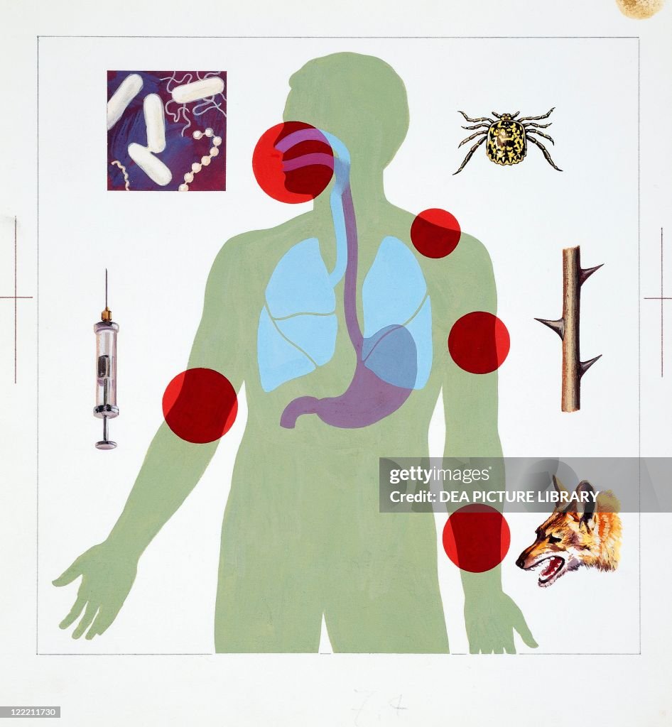 Draw Infect Medicine - Anatomy - Pathology - Infection. Drawing. News Photo - Getty ...